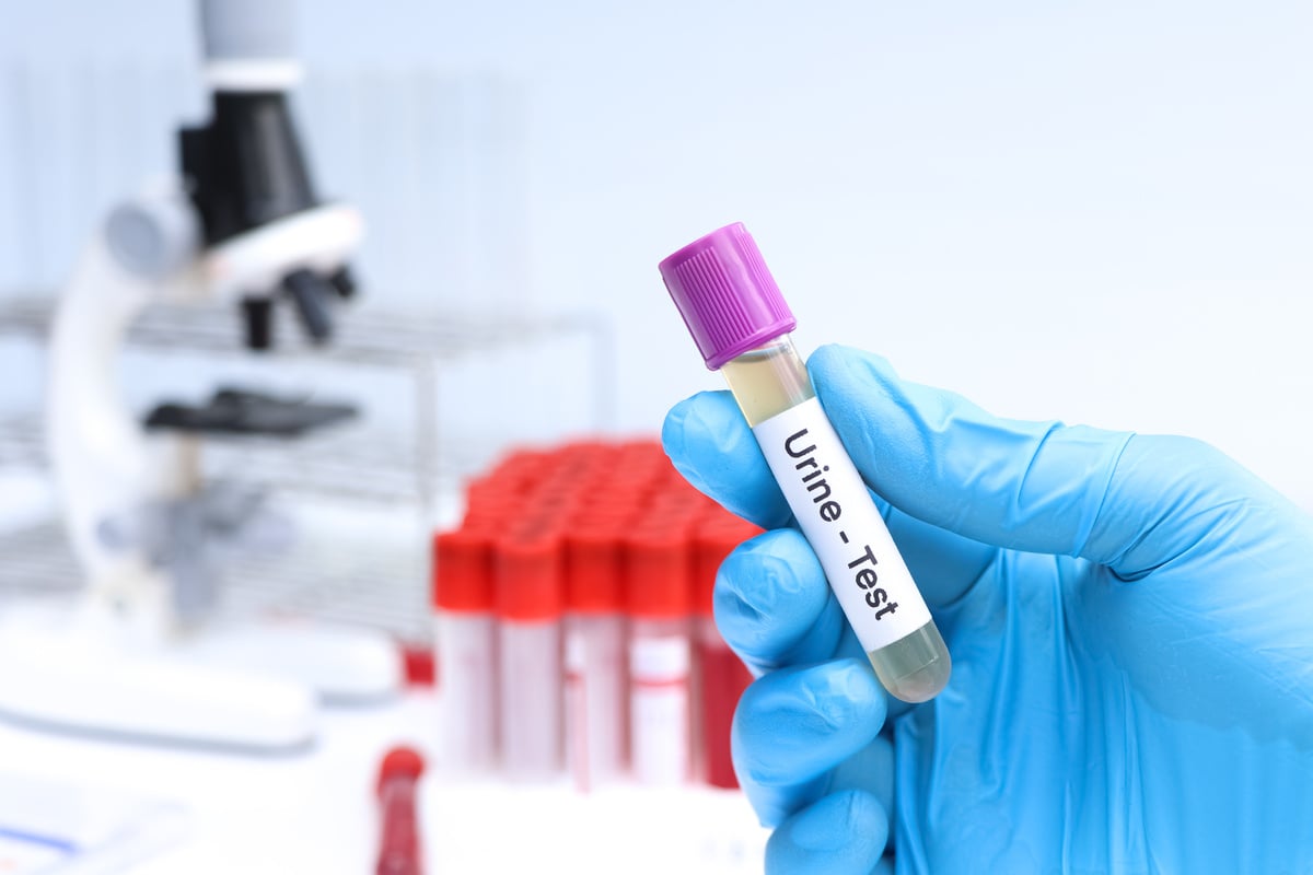 Urine test to look for abnormalities from Urine,  Urine sample to analyze in the laboratory